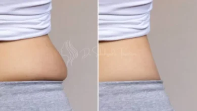 Liposuction in Dubai