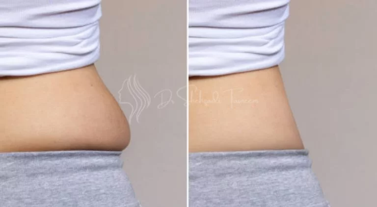 Liposuction in Dubai