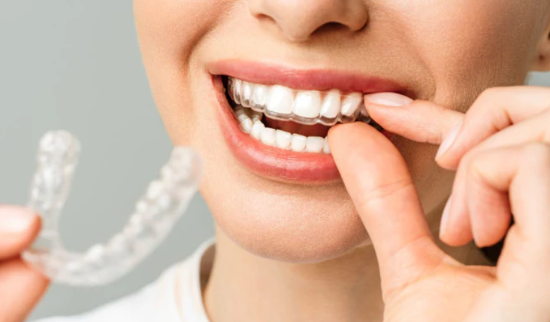 Top Benefits of Choosing Misaligned for a Straighter Smile